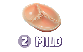 Stage 2: mild aortic stenosis