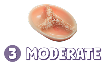 Stage 3: moderate aortic stenosis