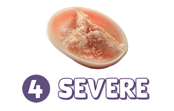 Stage 4: severe aortic stenosis