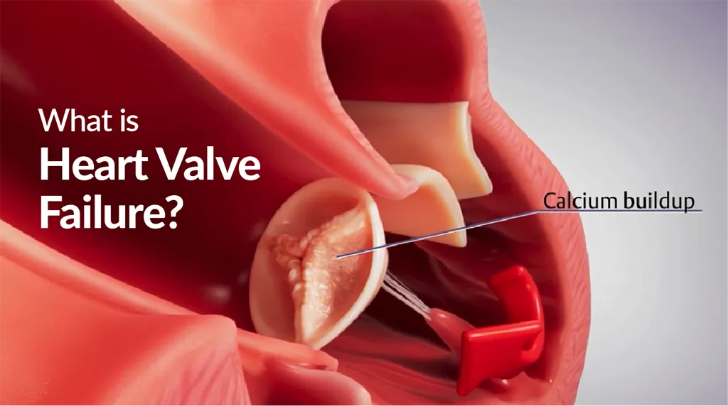 Video thumbnail: What is heart valve failure?