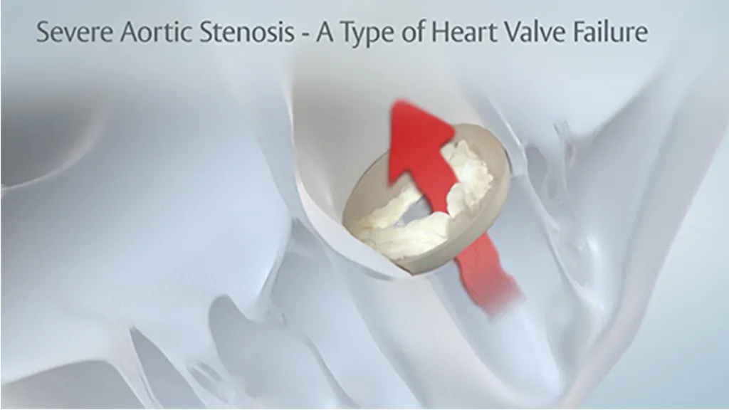 Video Thumbnail: How Aortic Stenosis Operates